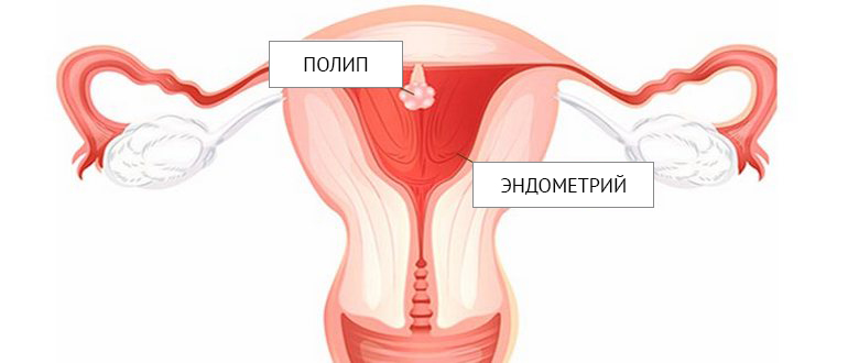 polipy-va-edometrii.jpg